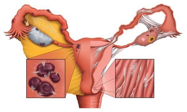 ENDOMETRIOSIS