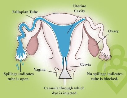 VARIOUS OVARIAN RESERVE FERTILITY TESTS