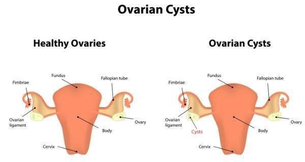 OVARIAN CYSTS