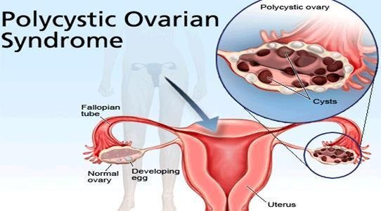 PCOS